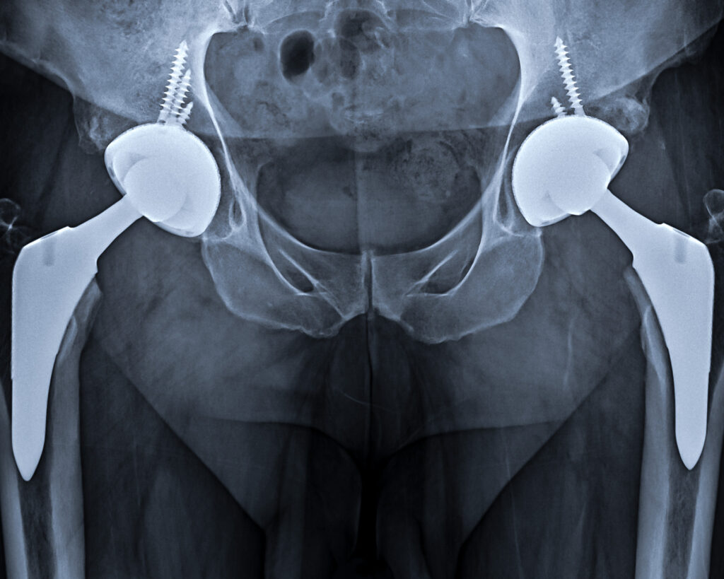 Hip Replacement ADAM SASSOON M.D., M.S.