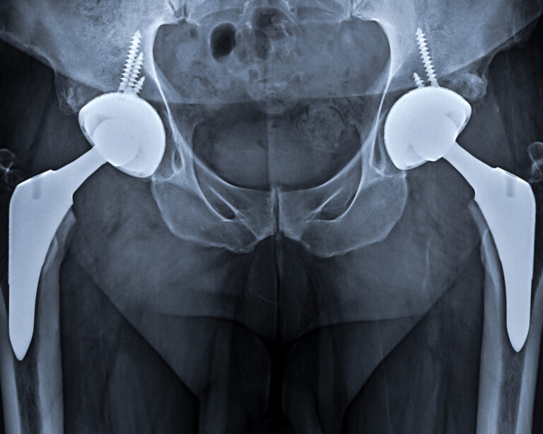 Hip Replacement – ADAM SASSOON M.D., M.S.